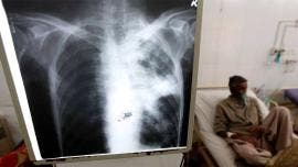 Tuberculosis