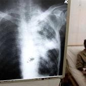 Tuberculosis